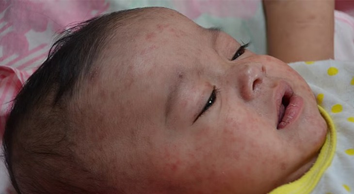 হাম ও জলবসন্তে আক্রান্ত শিশুর খাবার কেমন হওয়া উচিত