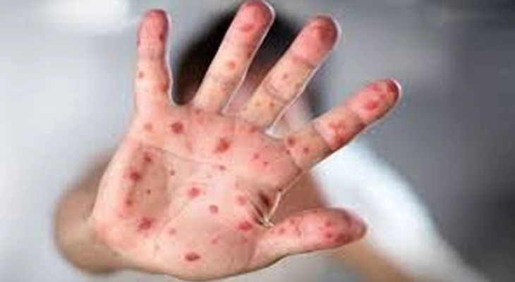 হামের উপসর্গে আরও এক শিশুর মৃত্যু